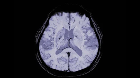 MRI brain axial plane . Stock Footage 116335593