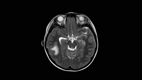MRI OF THE BRAIN A BOY 8 YEAR OLD HISTORY: Headache for3 days Finding A large Stock Footage 158902249