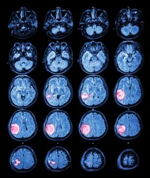 Mri brain : brain tumor at right parietal lobe Stock Photos