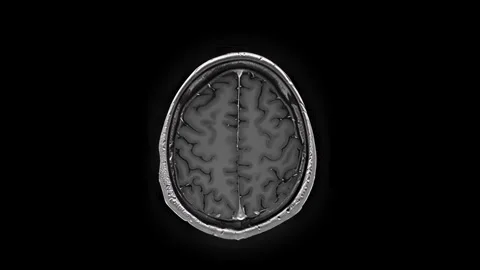MRI of the Brain with Contrast Agent 4K Stock Footage 329365070