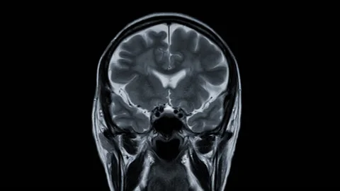 MRI Brain Coronal T2W . Stock Footage 152724769