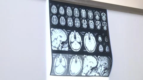 MRI of the brain in different projections Stock Footage 306397554