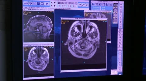MRI of brain Stock Footage 10903126