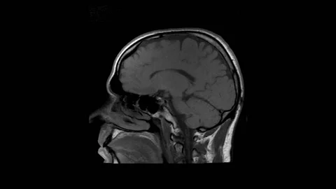 MRI Brain Stock Footage 139724476