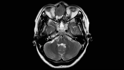 MRI Brain  Stock Footage 158902079
