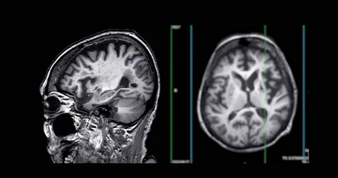 MRI of the brain. Stock Footage 201428011