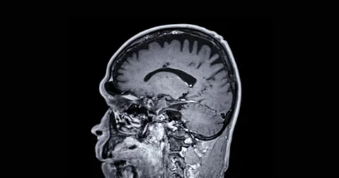 MRI of the brain | Stock Video | Pond5
