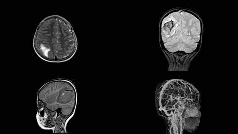 MRI OF BRAIN Impression: A 5cm isodensity mass with ill defined margin and su Stock Footage 158902124