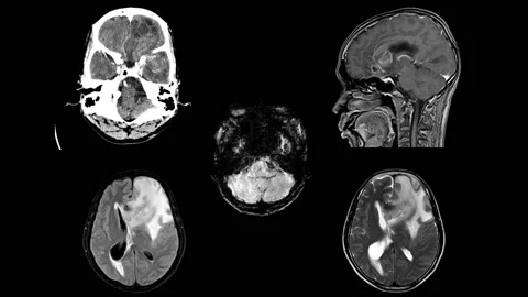 MRI OF BRAIN Impression: A 5cm isodensity mass with ill defined margin and su Stock Footage 158902131