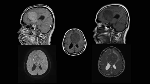 MRI OF BRAIN Impression: A 5cm isodensity mass with ill defined margin and su Stock Footage 158902132