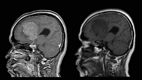 MRI OF BRAIN Impression: A 5cm isodensity mass with ill defined margin and su Stock Footage 158902133