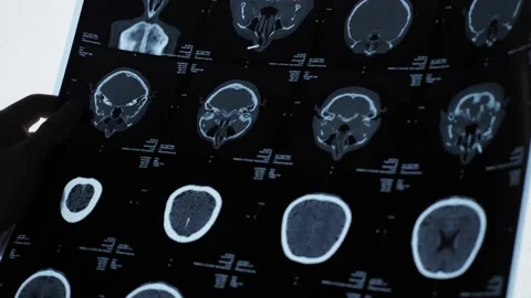 MRI of the brain of an older man Stock Footage 148532914