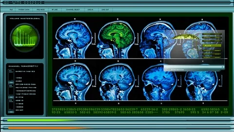 MRI Brain Scan 2 Stock Footage 94688768