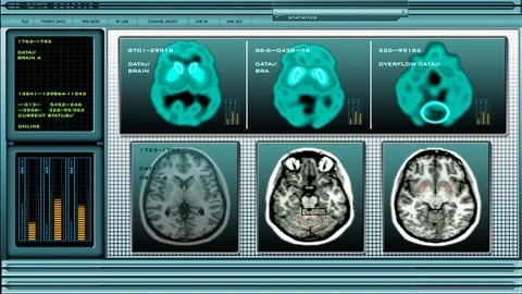 MRI Brain Scan 3 Stock Footage 94688772