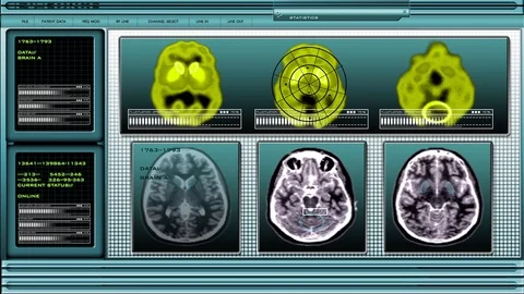 MRI Brain Scan 5 Stock Footage 94688782