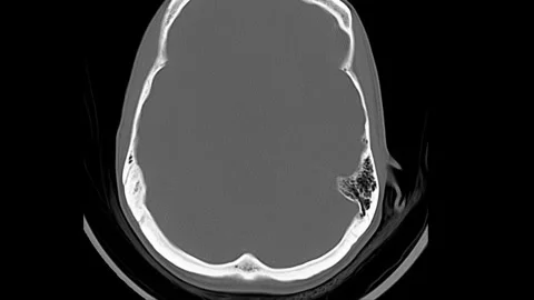 MRI Brain Scan Analysis: Examining Neural Structures and Potential Anomalies Stock Footage 316801304