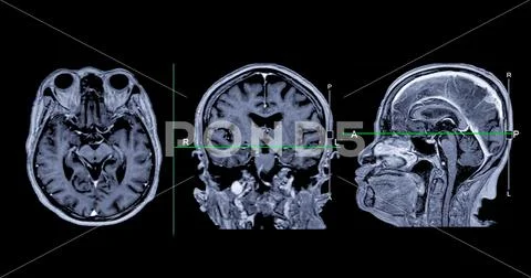 MRI brain scan Axial , Coronal and sagittal view with referance line ...