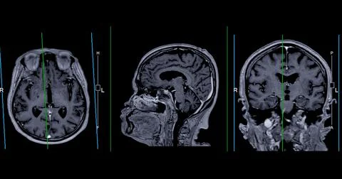 MRI  brain scan Axial , Coronal and sagittal view with referance line for d.. Stock Illustration