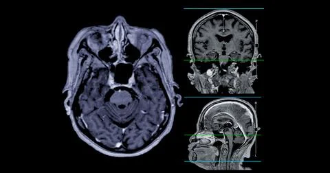 MRI  brain scan Axial , Coronal and sagittal view with referance line for d.. Illustrazione stock
