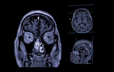 MRI  brain scan Axial , Coronal and sagittal view with referance line for d.. Stock Illustration