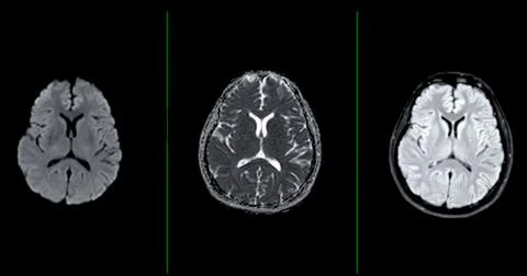 MRI  brain scan  axial Diffusion technique  for detect  Brain  diseases sus.. Stock Illustration