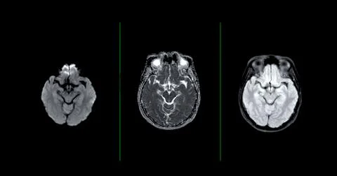 MRI  brain scan  axial Diffusion technique  for detect  Brain  diseases sus.. Stock Illustration