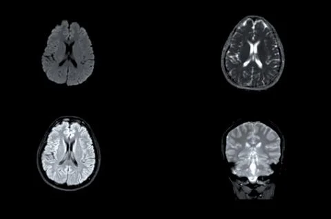 MRI  brain scan  axial Diffusion technique and coronal gredient  for detect.. Stock Illustration