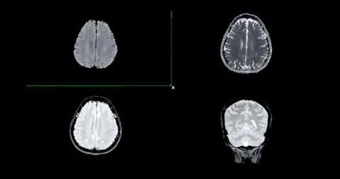 MRI  brain scan  axial Diffusion technique and coronal gredient  for detect.. Stock Illustration