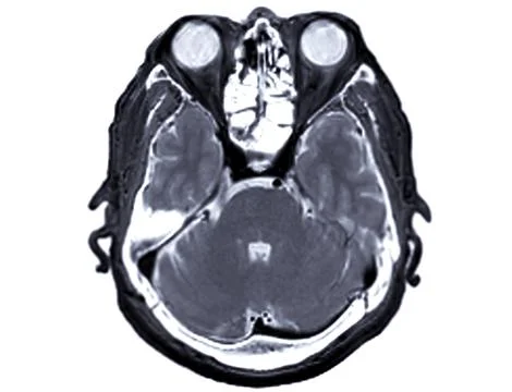 MRI  brain scan  axial view for detect  Brain  diseases sush as stroke dise.. Stock Illustration