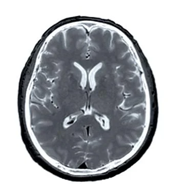 MRI  brain scan  axial view for detect  Brain  diseases sush as stroke dise.. Stock Illustration