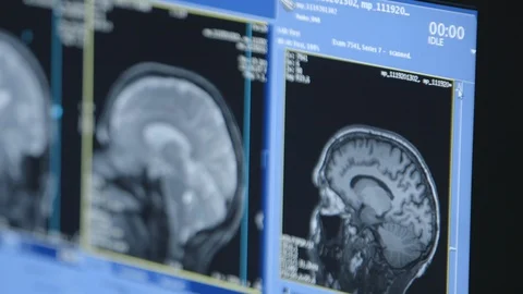 MRI Brain scan changing closeup Stock Footage 128982199