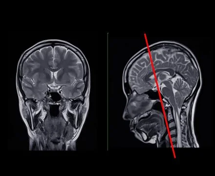 MRI  brain scan  Compare Coronal and sagittal plane for detect  Brain  dise.. Illustrazione stock