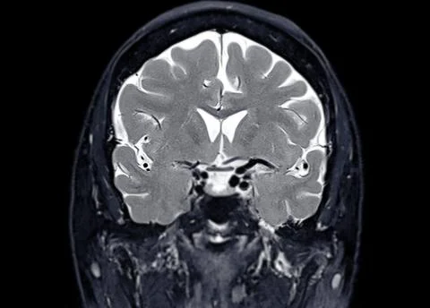 MRI  brain scan  Coronal T2W  for detect  Brain  diseases sush as stroke di.. Stock Illustration