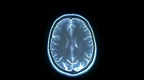 MRI brain scan Vidéo 63207400