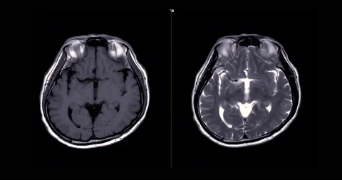 MRI Brain scan . | Stock Video | Pond5