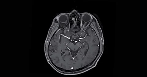 MRI Brain scan . | Stock Video | Pond5