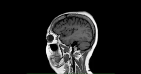 MRI Brain scan. Stock Footage 279290644