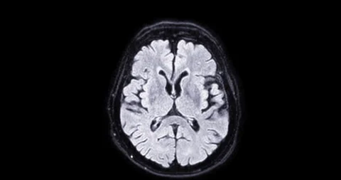 MRI Brain scan. Stock Footage 279290679