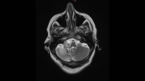 Mri Brain Scan. Human Brain. Stock Footage 134894187