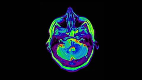 Mri Brain Scan. Human Brain. Stock Footage 134894188