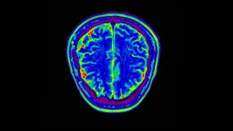 Mri Brain Scan. Human Brain. 스톡 동영상 134964220