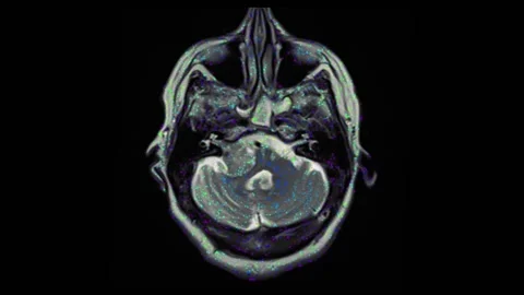 Mri Brain Scan. Human Brain. Stock Footage 134965093