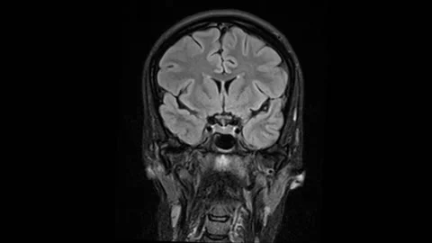 Mri Brain Scan. Human Brain. Stock Footage 136041557