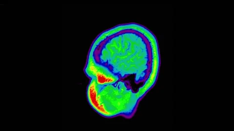 Mri Brain Scan. Human Brain. 스톡 동영상 136117271