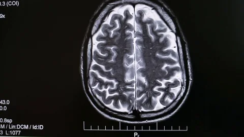 MRI brain scan images Stock Footage 85319619