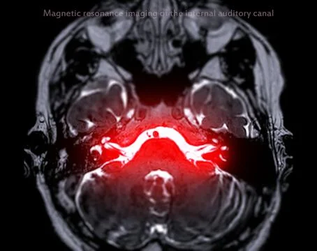 MRI Brain scan  with  the internal auditory canal (IAC) axial view. Stock Illustration