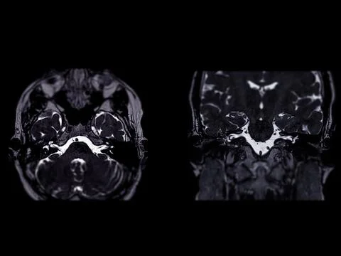 MRI Brain scan  with  the internal auditory canal (IAC) axial  and Coronal .. Illustrazione stock
