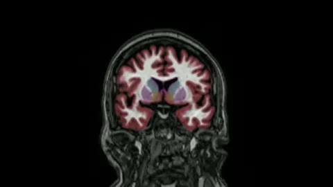 MRI brain scan magnetic resonance imaging top Neurology data analysis process Stock Footage 336561067