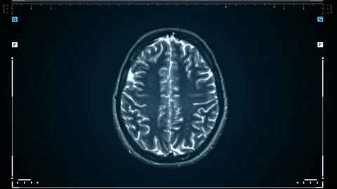 MRI brain scan magnetic resonance imaging top Neurology data analysis process Stock Footage 336561111