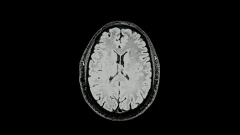 MRI brain scan magnetic resonance imaging top Neurology data analysis process Stock Footage 336561153